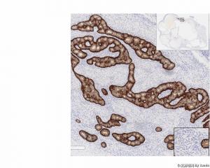 Neuroendocrine tumor arising in association with a mature cystic teratoma？请问有沒其他名字替代？图5