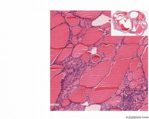 Neuroendocrine tumor arising in association with a mature cystic teratoma？请问有沒其他名字替代？图3