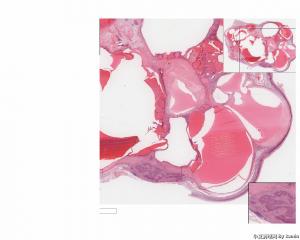 Neuroendocrine tumor arising in association with a mature cystic teratoma？请问有沒其他名字替代？图1