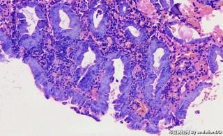 普遍医院的胃肠镜组织都会出现的情况，染色腺体位置发灰发白图1