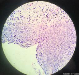 脐部皮肤赘生物图23