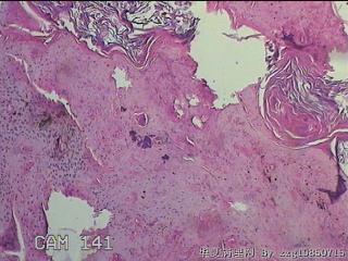 头部赘生物图22