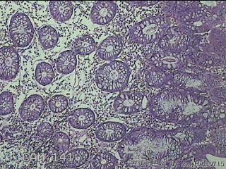 远端横结肠粘膜图34
