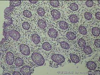 远端横结肠粘膜图43