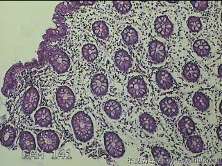 远端横结肠粘膜图45