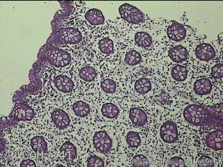 远端横结肠粘膜图44