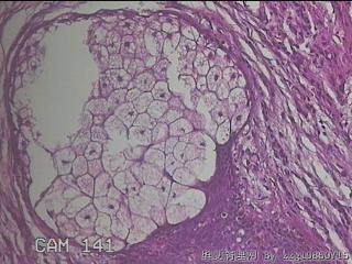 右肩部皮肤赘生物图29