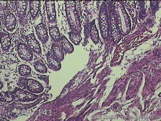乙状结肠粘膜图11