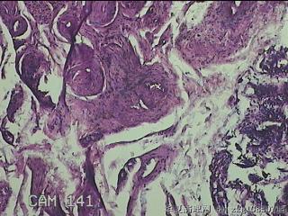 乙状结肠粘膜图3
