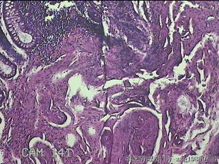 乙状结肠粘膜图4