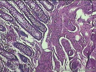 乙状结肠粘膜图5