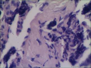 女，52岁，乳腺肿物，碎组织，大小1.5*1*0.5cm图8
