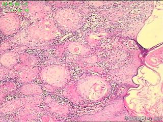 额部皮肤肿物，高分化鳞癌？图1