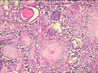 额部皮肤肿物，高分化鳞癌？图4