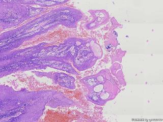 疣状增生？溃疡？图13