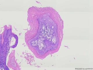 疣状增生？溃疡？图12