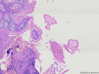 疣状增生？溃疡？图7