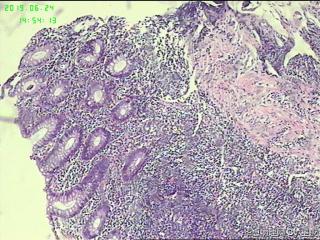 结肠溃疡，请教？图2