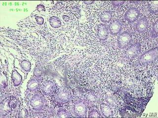 结肠溃疡，请教？图4