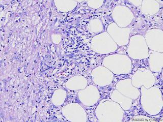 脂肪肉瘤？图8