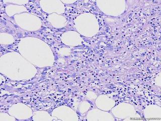 脂肪肉瘤？图13