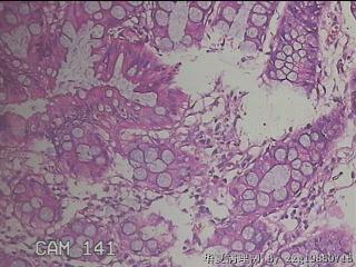 乙状结肠粘膜图22
