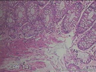 乙状结肠粘膜图32