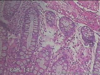 乙状结肠粘膜图25