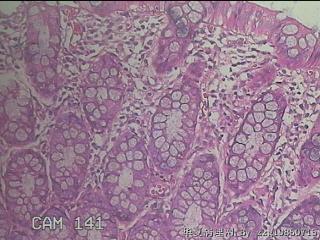 乙状结肠粘膜图33
