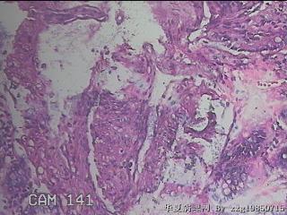 乙状结肠粘膜图45