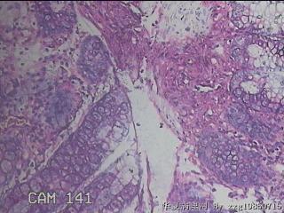 乙状结肠粘膜图44