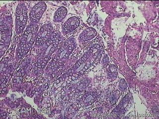 乙状结肠粘膜图11