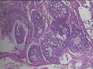 乙状结肠粘膜图48