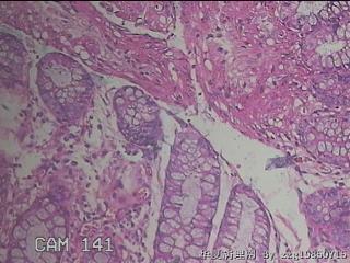 乙状结肠粘膜图21