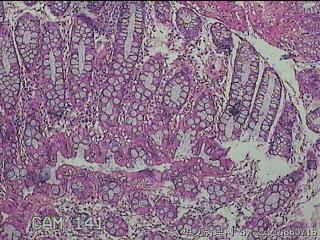乙状结肠粘膜图5