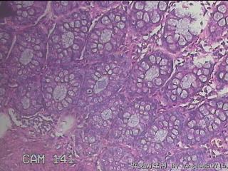 乙状结肠粘膜图47