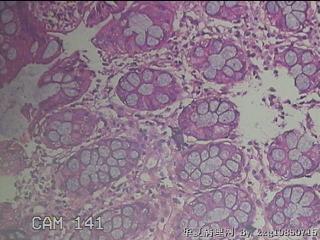 乙状结肠粘膜图29