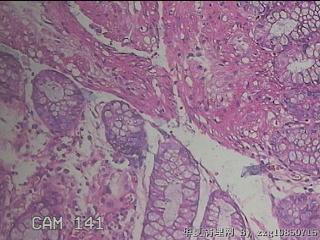 乙状结肠粘膜图23