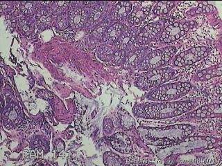 乙状结肠粘膜图9