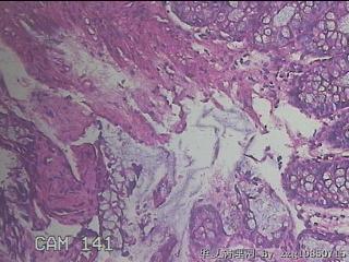 乙状结肠粘膜图46