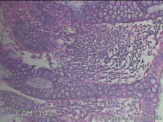 乙状结肠粘膜图43