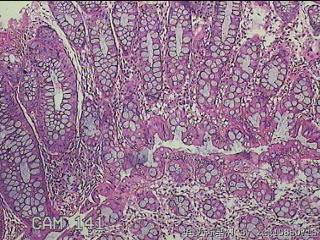 乙状结肠粘膜图3