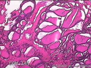 右侧甲状腺肿物图9