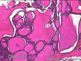 右侧甲状腺肿物图47