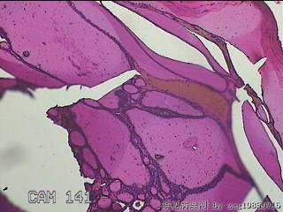 右侧甲状腺肿物图27