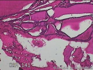 右侧甲状腺肿物图46