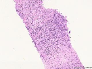 肌纤维母细胞瘤？图2