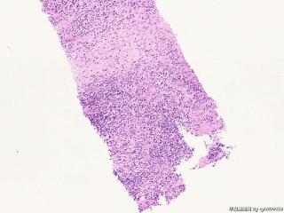 肌纤维母细胞瘤？图8