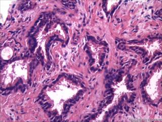 前列腺穿刺组织，18-19图是癌吗？图6