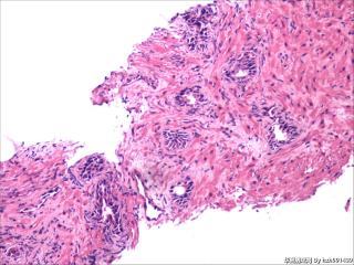前列腺穿刺组织，18-19图是癌吗？图8